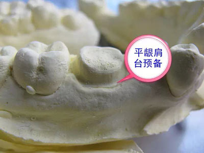 備牙應注意的事項+備牙取摸損傷牙齦問題 備牙應注意的事項+備牙取摸損傷牙齦問題