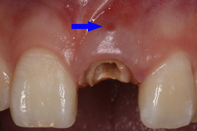 根管側(cè)穿修補(bǔ)方法 根管側(cè)穿修補(bǔ)方法