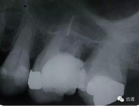 根管治療的并發(fā)癥及處理