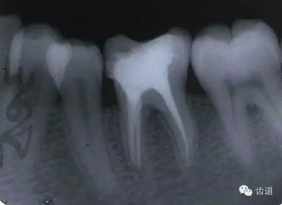 根管治療的并發(fā)癥及處理