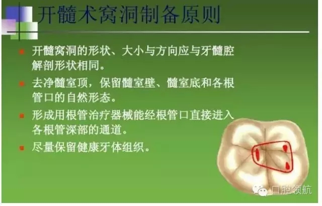 開(kāi)髓術(shù) 開(kāi)髓術(shù)