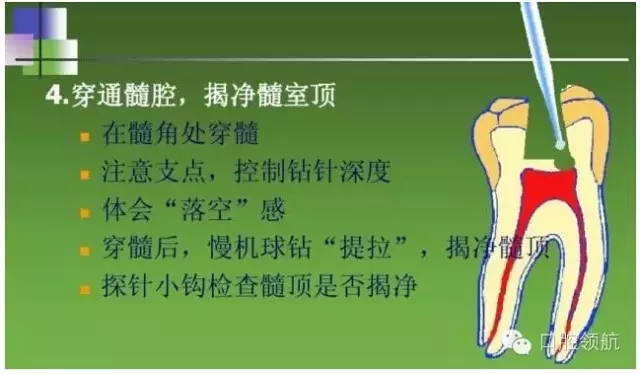 開(kāi)髓術(shù) 開(kāi)髓術(shù)