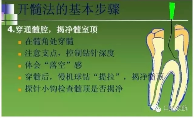 開(kāi)髓術(shù) 開(kāi)髓術(shù)