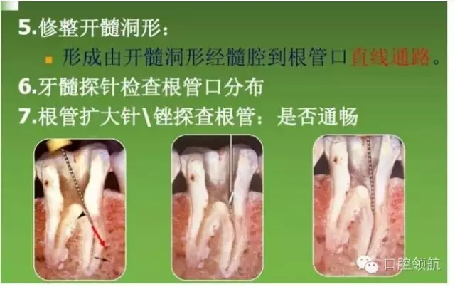 開(kāi)髓術(shù) 開(kāi)髓術(shù)