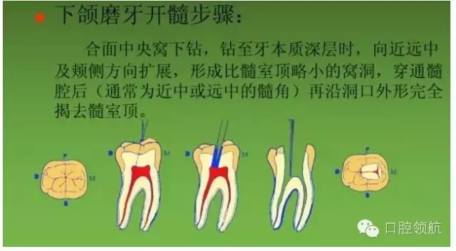 開(kāi)髓術(shù) 開(kāi)髓術(shù)