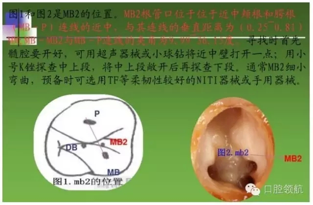 開(kāi)髓術(shù) 開(kāi)髓術(shù)