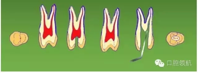 開(kāi)髓術(shù) 開(kāi)髓術(shù)