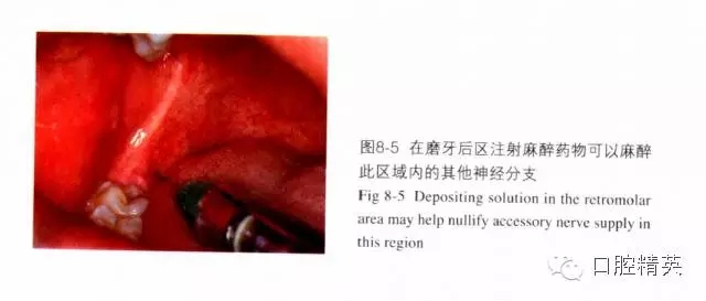 分析局部麻醉失敗的常見原因 分析局部麻醉失敗的常見原因