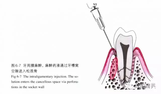 分析局部麻醉失敗的常見原因 分析局部麻醉失敗的常見原因