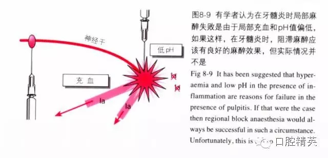 分析局部麻醉失敗的常見原因 分析局部麻醉失敗的常見原因