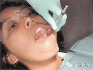 防霧化吸唾口鏡 防霧化吸唾口鏡