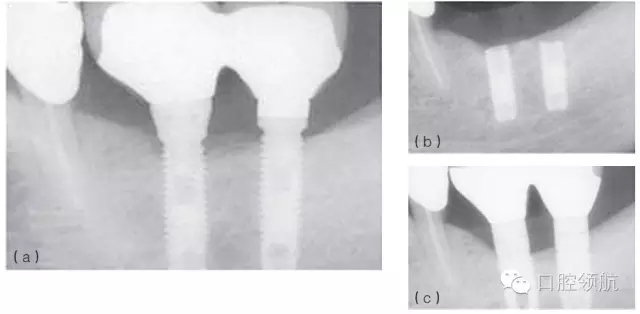 種植體失敗的病因和危險因素 種植體失敗的病因和危險因素