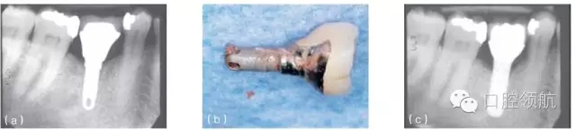 種植體失敗的病因和危險因素 種植體失敗的病因和危險因素