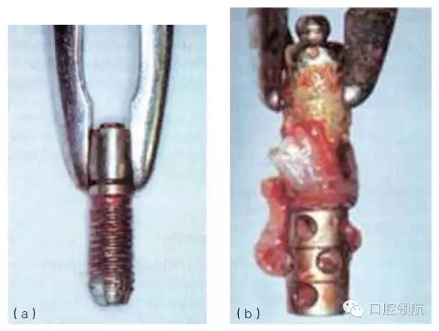 種植體失敗的病因和危險因素 種植體失敗的病因和危險因素