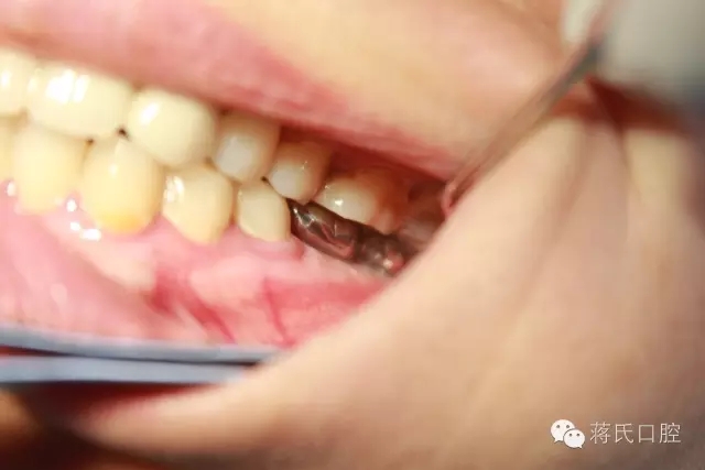 蔣氏口腔醫(yī)師風(fēng)采系列報道(五)左下六七即拔即種病歷分享 蔣氏口腔醫(yī)師風(fēng)采系列報道(五)左下六七即拔即種病歷分享