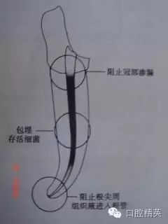 關(guān)于根管治療過程中的“激惹”現(xiàn)象 關(guān)于根管治療過程中的“激惹”現(xiàn)象