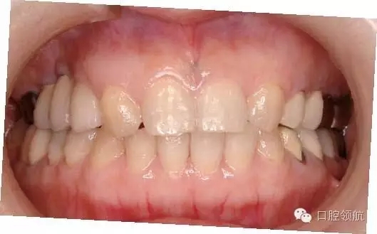 兩次手術(shù)法植入植體后數(shù)天，覆蓋螺絲暴露