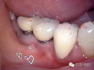 種植體周圍出現(xiàn)伴有骨密度增加現(xiàn)象的骨吸收 種植體周圍出現(xiàn)伴有骨密度增加現(xiàn)象的骨吸收