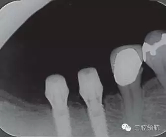 種植體周圍出現(xiàn)伴有骨密度增加現(xiàn)象的骨吸收 種植體周圍出現(xiàn)伴有骨密度增加現(xiàn)象的骨吸收