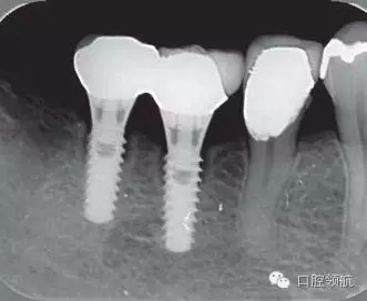 種植體周圍出現(xiàn)伴有骨密度增加現(xiàn)象的骨吸收 種植體周圍出現(xiàn)伴有骨密度增加現(xiàn)象的骨吸收