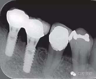 種植體周圍出現(xiàn)伴有骨密度增加現(xiàn)象的骨吸收 種植體周圍出現(xiàn)伴有骨密度增加現(xiàn)象的骨吸收
