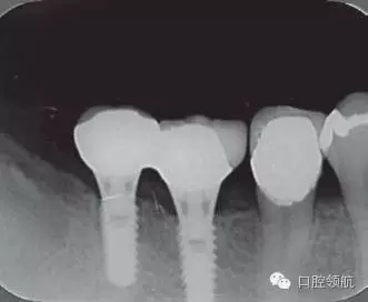 種植體周圍出現(xiàn)伴有骨密度增加現(xiàn)象的骨吸收 種植體周圍出現(xiàn)伴有骨密度增加現(xiàn)象的骨吸收