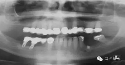 口腔種植各種失敗模式的病因探查 口腔種植各種失敗模式的病因探查