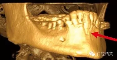 口腔種植各種失敗模式的病因探查 口腔種植各種失敗模式的病因探查