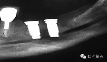 口腔種植各種失敗模式的病因探查 口腔種植各種失敗模式的病因探查