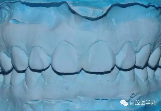 樹(shù)脂關(guān)閉前牙間隙 樹(shù)脂關(guān)閉前牙間隙