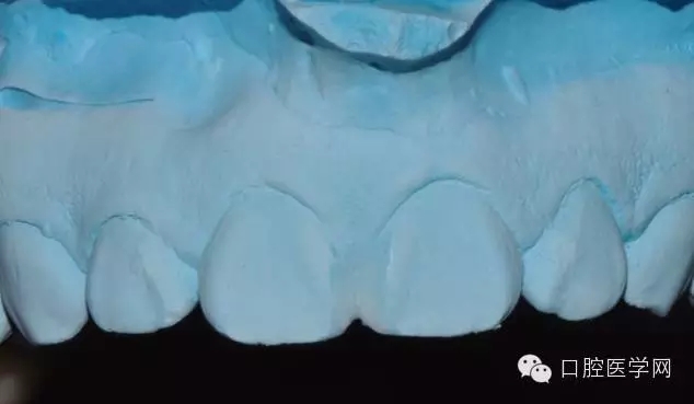 樹(shù)脂關(guān)閉前牙間隙 樹(shù)脂關(guān)閉前牙間隙