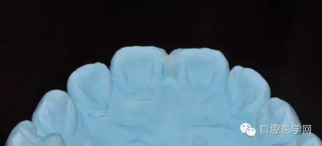 樹(shù)脂關(guān)閉前牙間隙 樹(shù)脂關(guān)閉前牙間隙