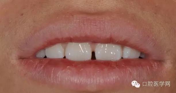樹(shù)脂關(guān)閉前牙間隙 樹(shù)脂關(guān)閉前牙間隙