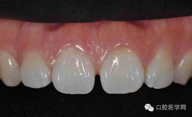 樹(shù)脂關(guān)閉前牙間隙 樹(shù)脂關(guān)閉前牙間隙
