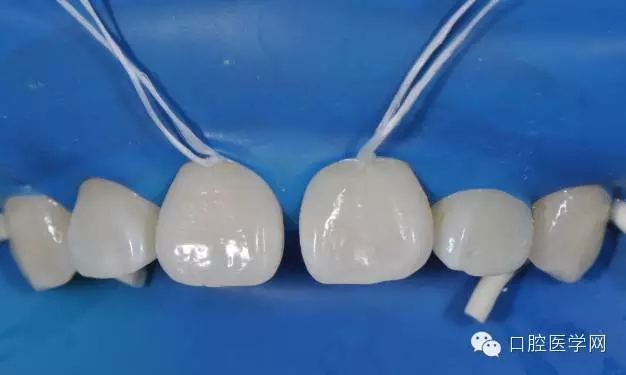 樹(shù)脂關(guān)閉前牙間隙 樹(shù)脂關(guān)閉前牙間隙