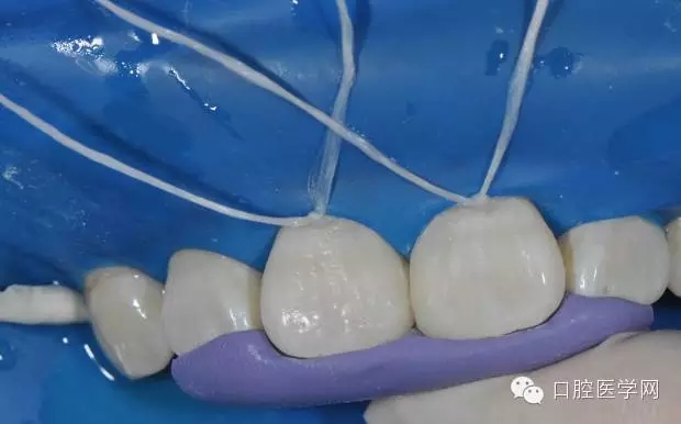 樹(shù)脂關(guān)閉前牙間隙 樹(shù)脂關(guān)閉前牙間隙