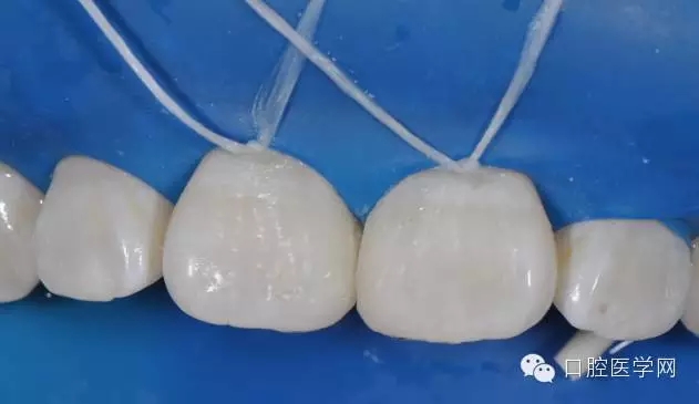 樹(shù)脂關(guān)閉前牙間隙 樹(shù)脂關(guān)閉前牙間隙
