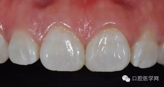 6樹(shù)脂關(guān)閉前牙間隙 6樹(shù)脂關(guān)閉前牙間隙