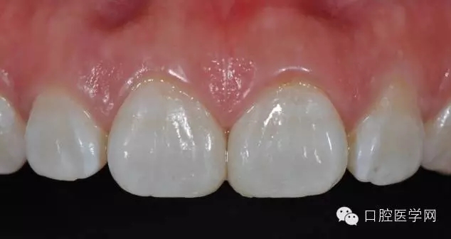 樹(shù)脂關(guān)閉前牙間隙 樹(shù)脂關(guān)閉前牙間隙