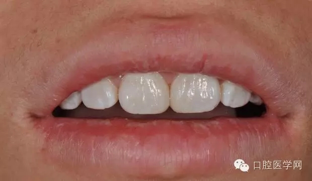 樹(shù)脂關(guān)閉前牙間隙 樹(shù)脂關(guān)閉前牙間隙