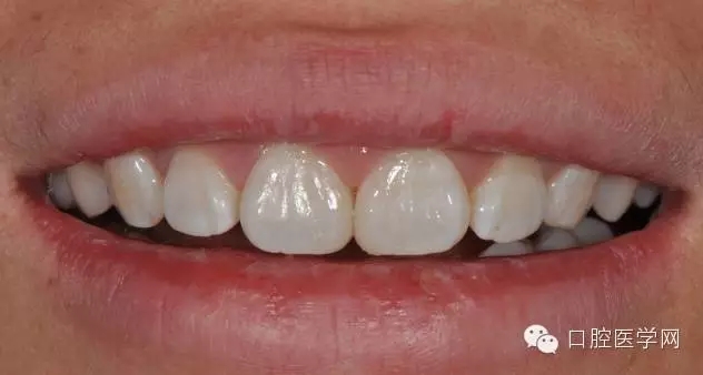 樹(shù)脂關(guān)閉前牙間隙 樹(shù)脂關(guān)閉前牙間隙