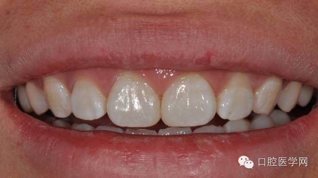 樹(shù)脂關(guān)閉前牙間隙 樹(shù)脂關(guān)閉前牙間隙