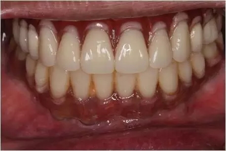 All-on-4上頜種植失敗一例及處理方法解析 All-on-4上頜種植失敗一例及處理方法解析