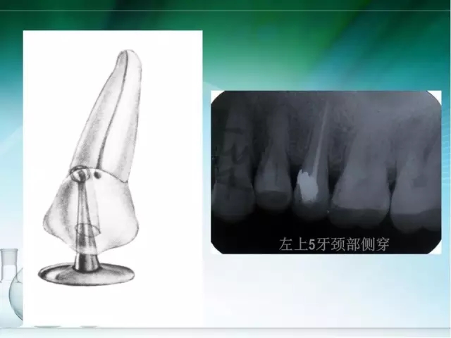 根管治療并發(fā)癥及處理 根管治療并發(fā)癥及處理