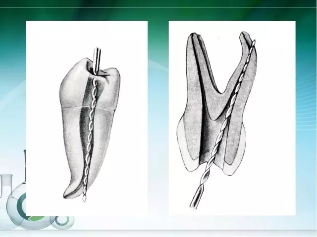 根管治療并發(fā)癥及處理 根管治療并發(fā)癥及處理