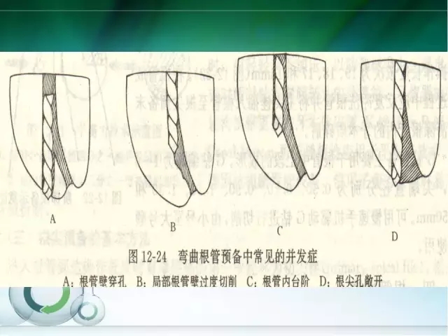 根管治療并發(fā)癥及處理 根管治療并發(fā)癥及處理