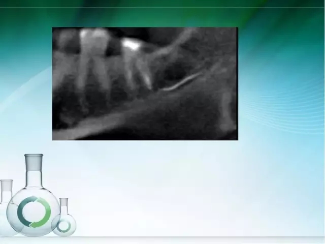 根管治療并發(fā)癥及處理 根管治療并發(fā)癥及處理