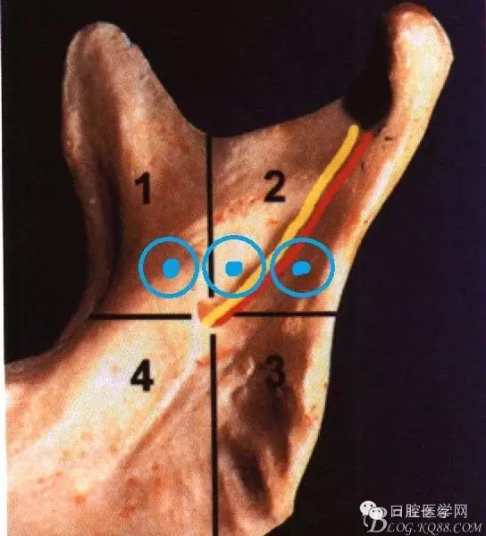 即使是老手也會失手的麻醉----下牙槽、舌、頰一次阻滯麻醉