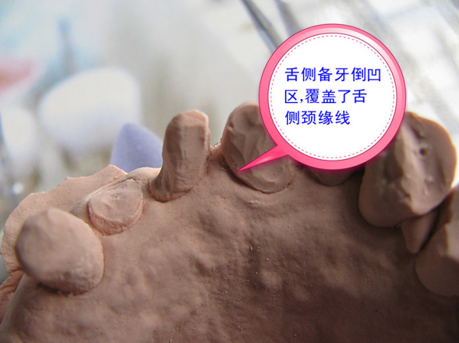 口腔修復(fù)醫(yī)生備牙取摸常見問題系列之——基牙倒凹 與 備牙時(shí)“就位道”的處理 口腔修復(fù)醫(yī)生備牙取摸常見問題系列之——基牙倒凹 與 備牙時(shí)“就位道”的處理