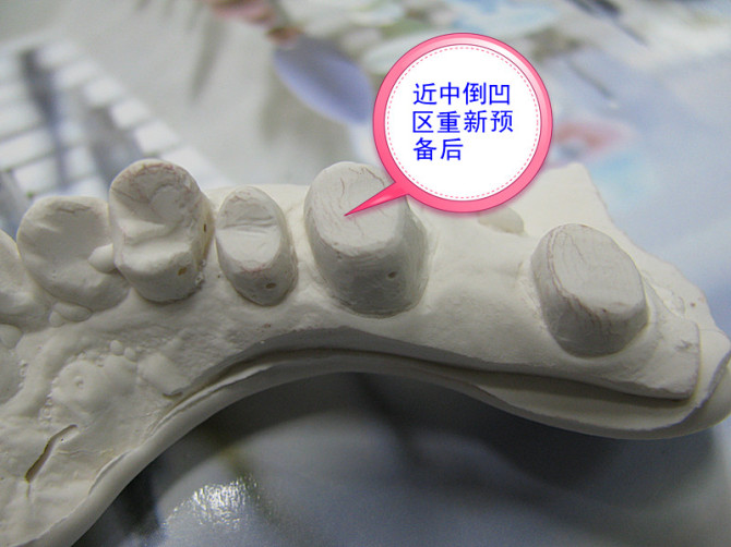 口腔修復(fù)醫(yī)生備牙取摸常見問題系列之——基牙倒凹 與 備牙時(shí)“就位道”的處理 口腔修復(fù)醫(yī)生備牙取摸常見問題系列之——基牙倒凹 與 備牙時(shí)“就位道”的處理